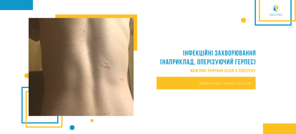Причини болю у попереку