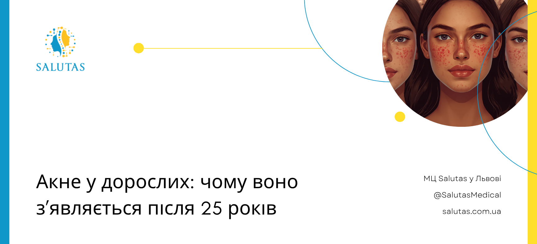Акне у дорослих: чому воно з’являється після 25 років
